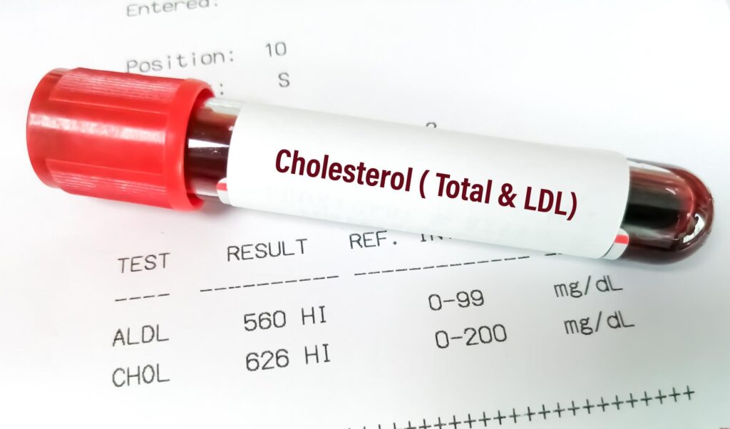 Wysoki cholesterol – przyczyny, objawy i sposoby obniżania poziomu cholesterolu