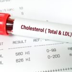 Wysoki cholesterol – przyczyny, objawy i sposoby obniżania poziomu cholesterolu
